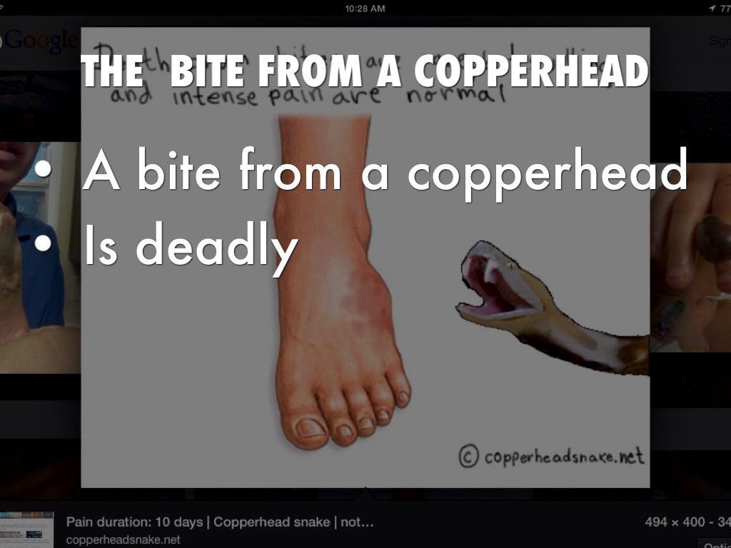 Copperhead Bite
