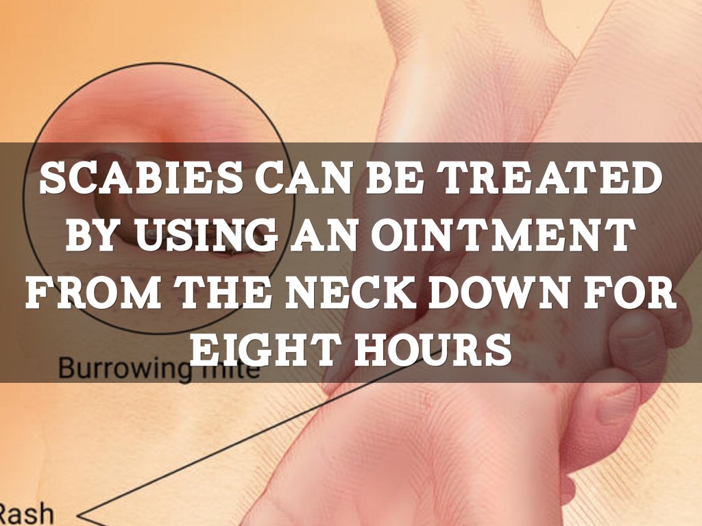 Scabies by Oliver Tibbs