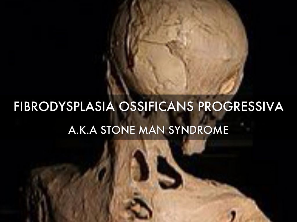 Fibrodysplasia Ossificans Progressiva 