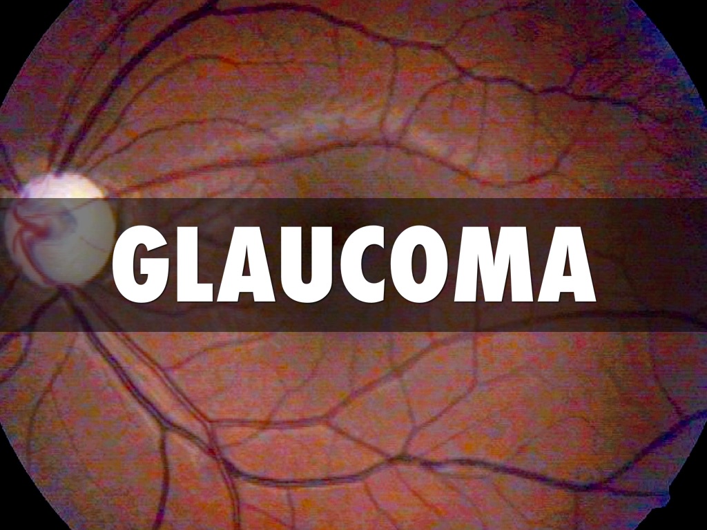 Title Glaucoma