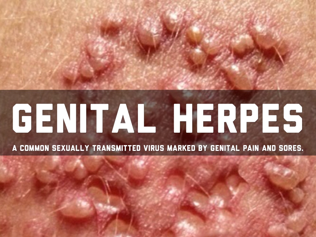 Genital Herpes