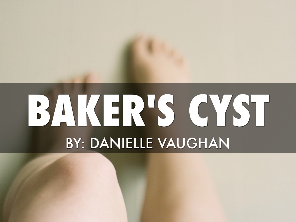 Baker's Cyst