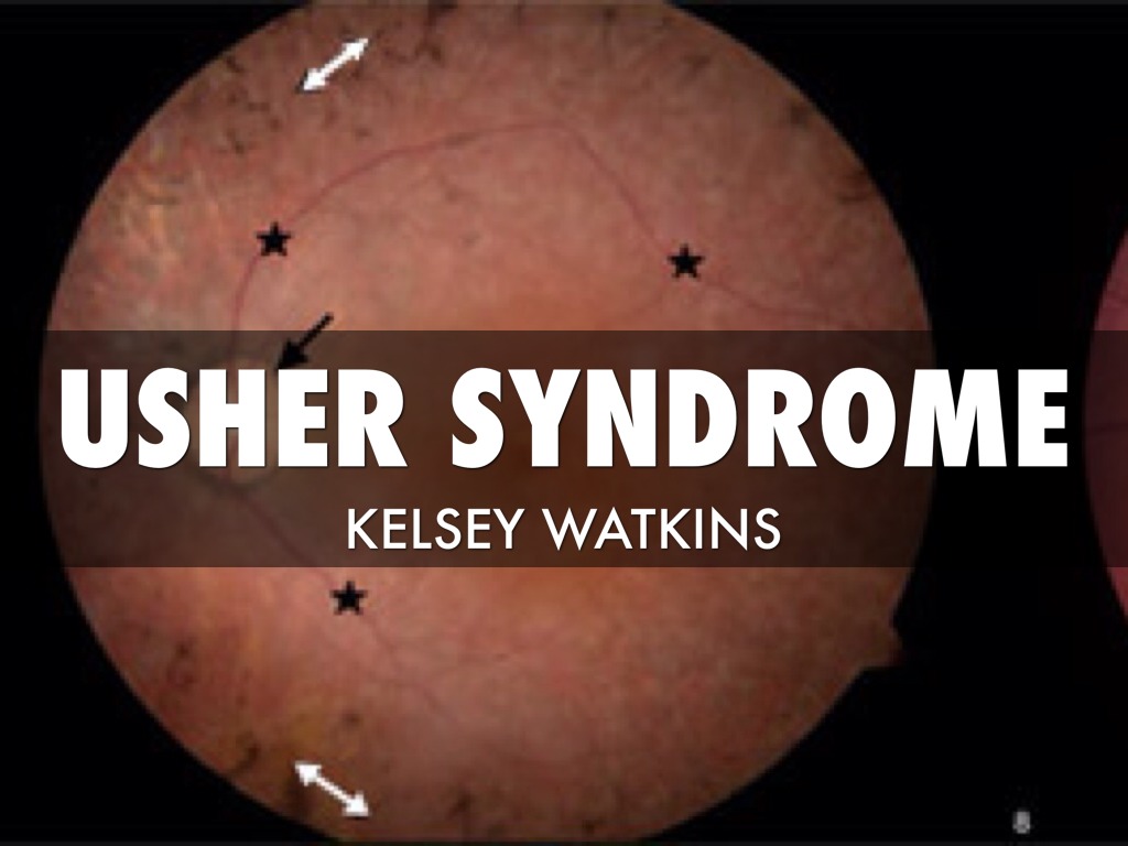 Usher Syndrome 
