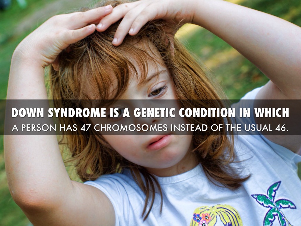 Down Syndrome 