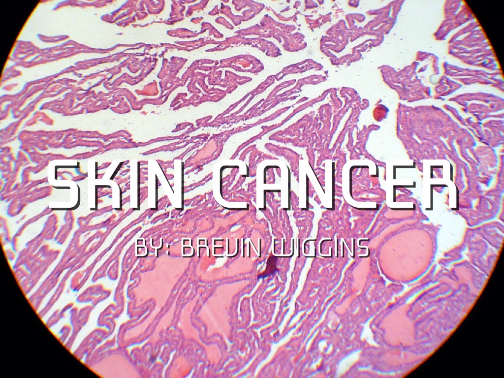 Skin Cancer