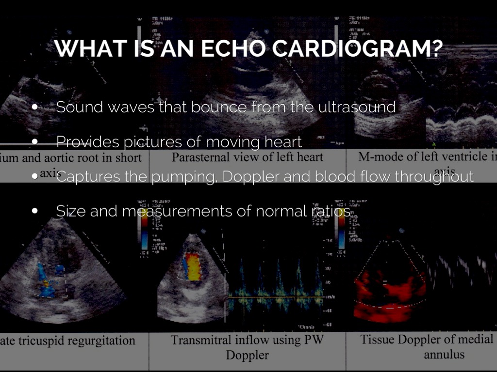 What Is An Echocardiogram by h2ghannah
