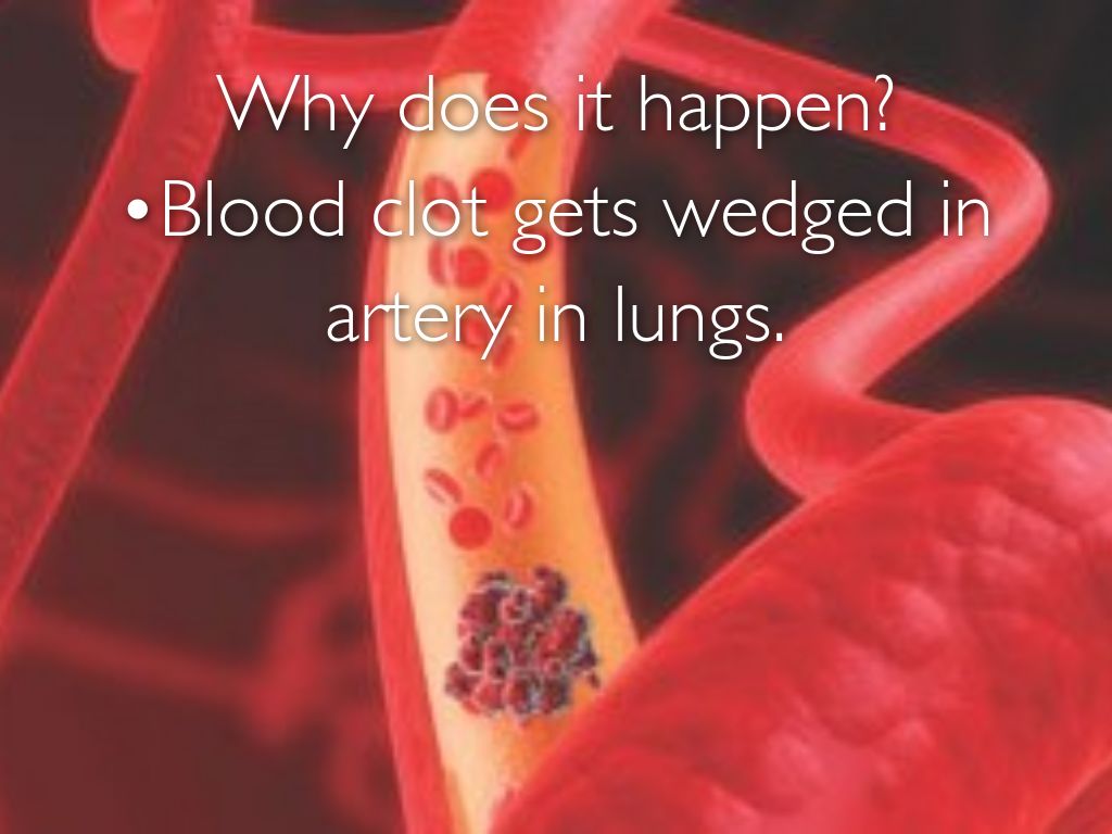 Pulmonary Embolism by Jennifer Lee