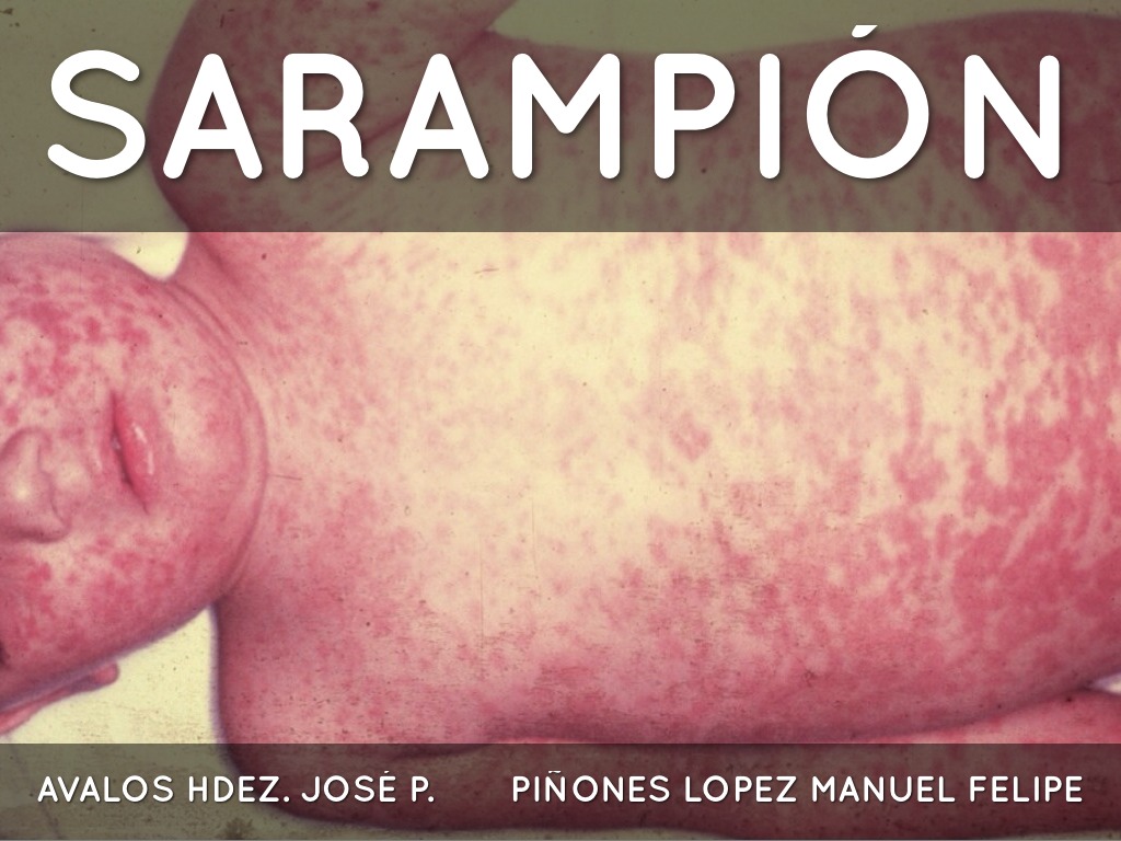 Sarampión