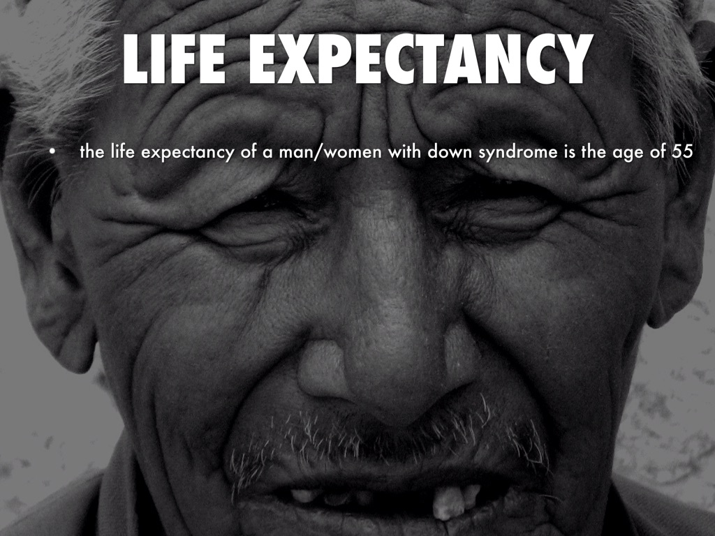 Downs Sydrome by Connor Prange