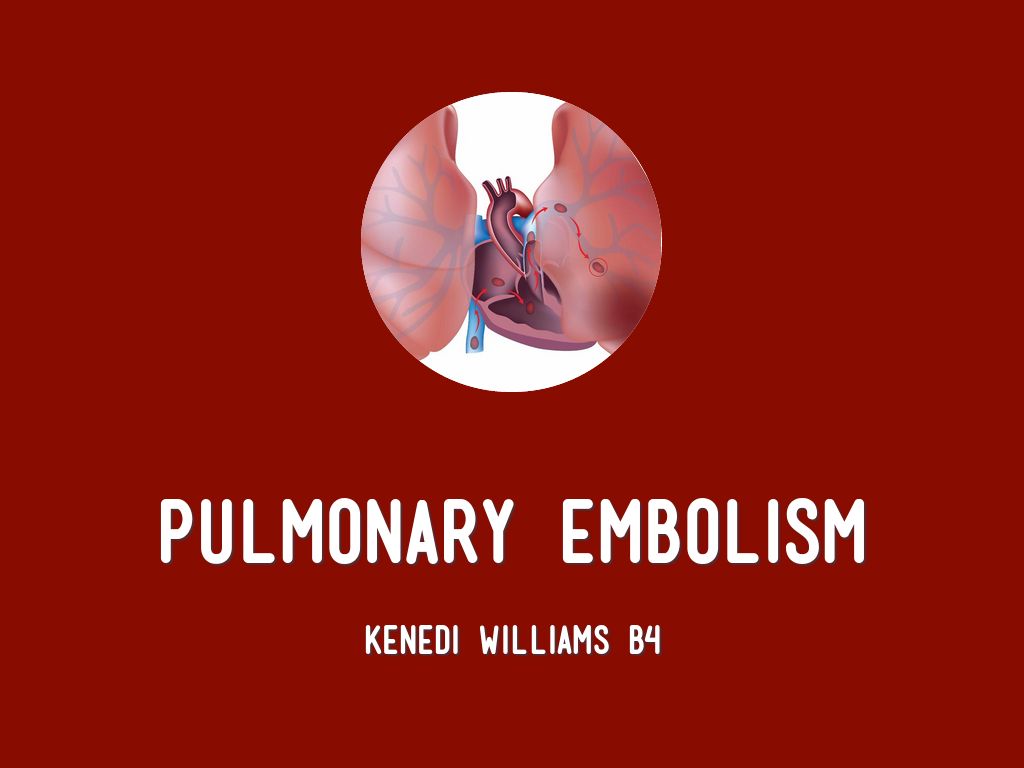 Pulmonary Embolism