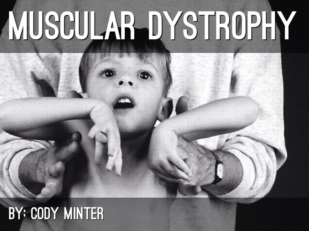 Muscular Dystrophy 