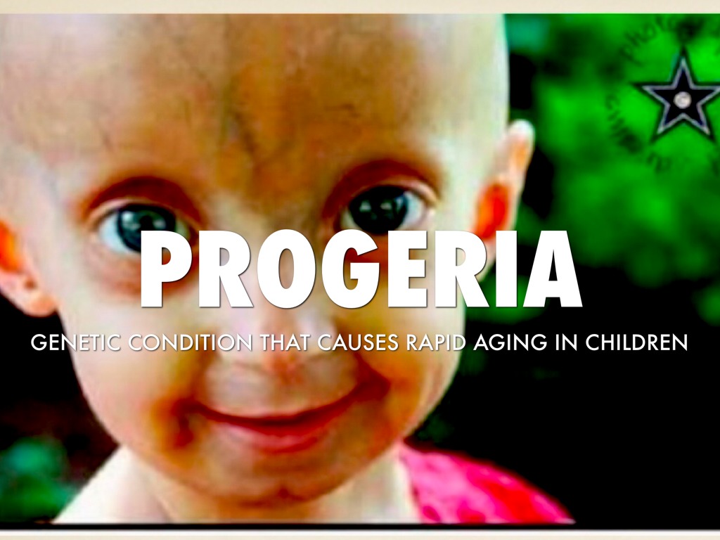 Progeria