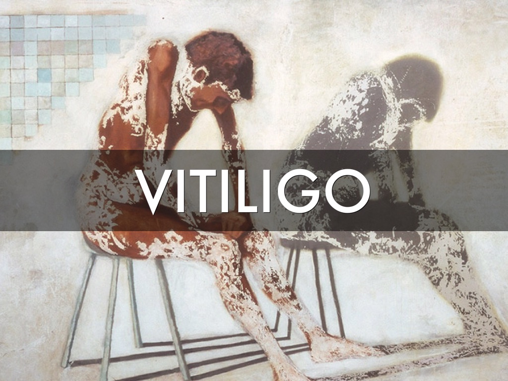 Vitiligo