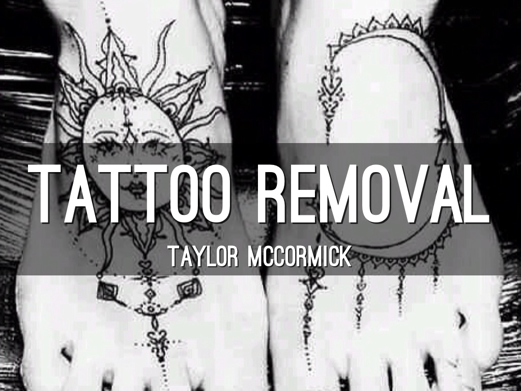 Tattoo Removal