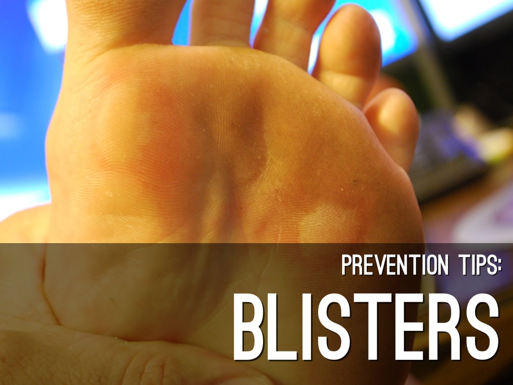 Prevention Tips: BLISTERS
