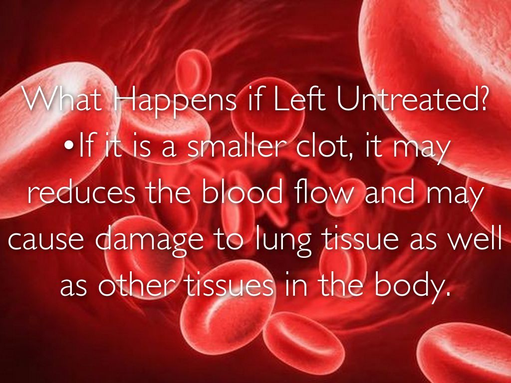 Pulmonary Embolism by Jennifer Lee