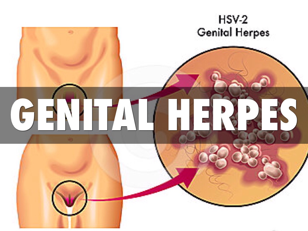 Herpes an der scheide
