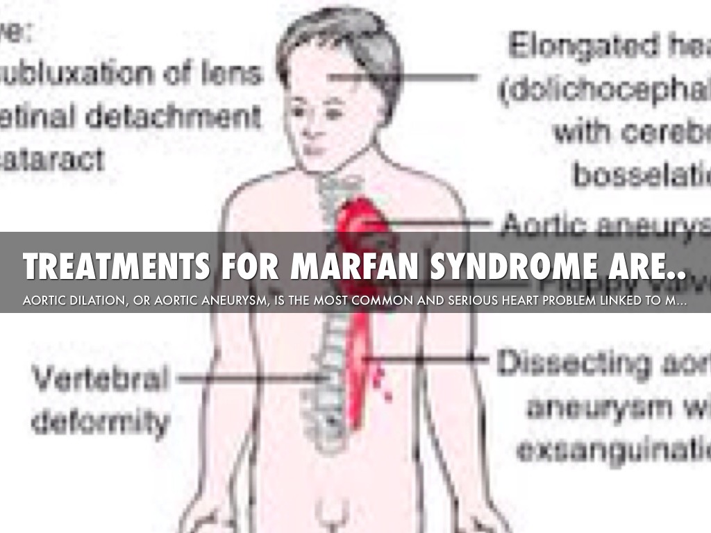 Marfan syndrome что это