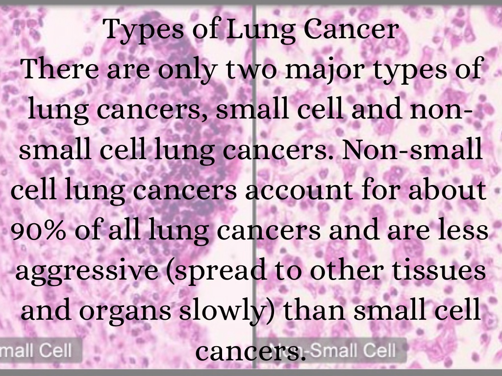 Lung Cancer by Lanie