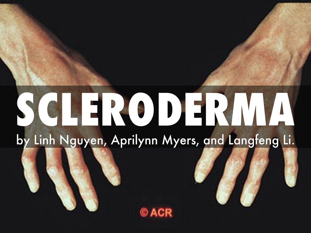 Scleroderma by Linh Nguyen
