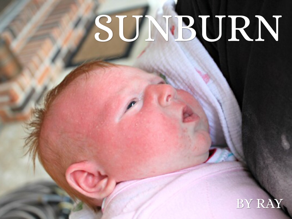Sunburn