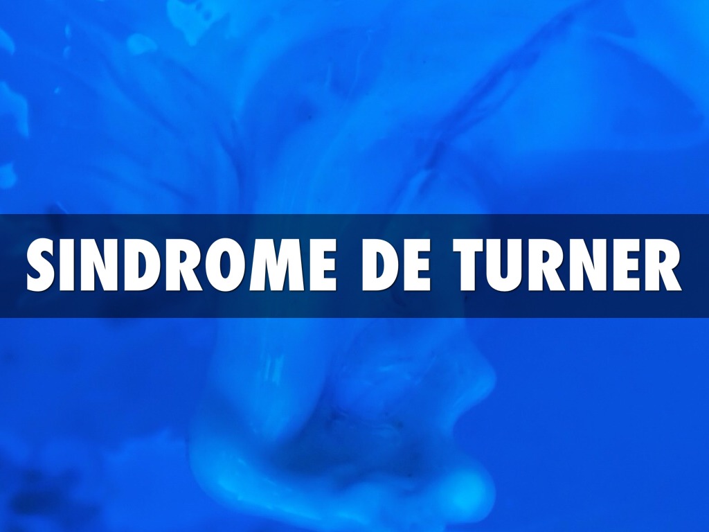Sindrome De Turner