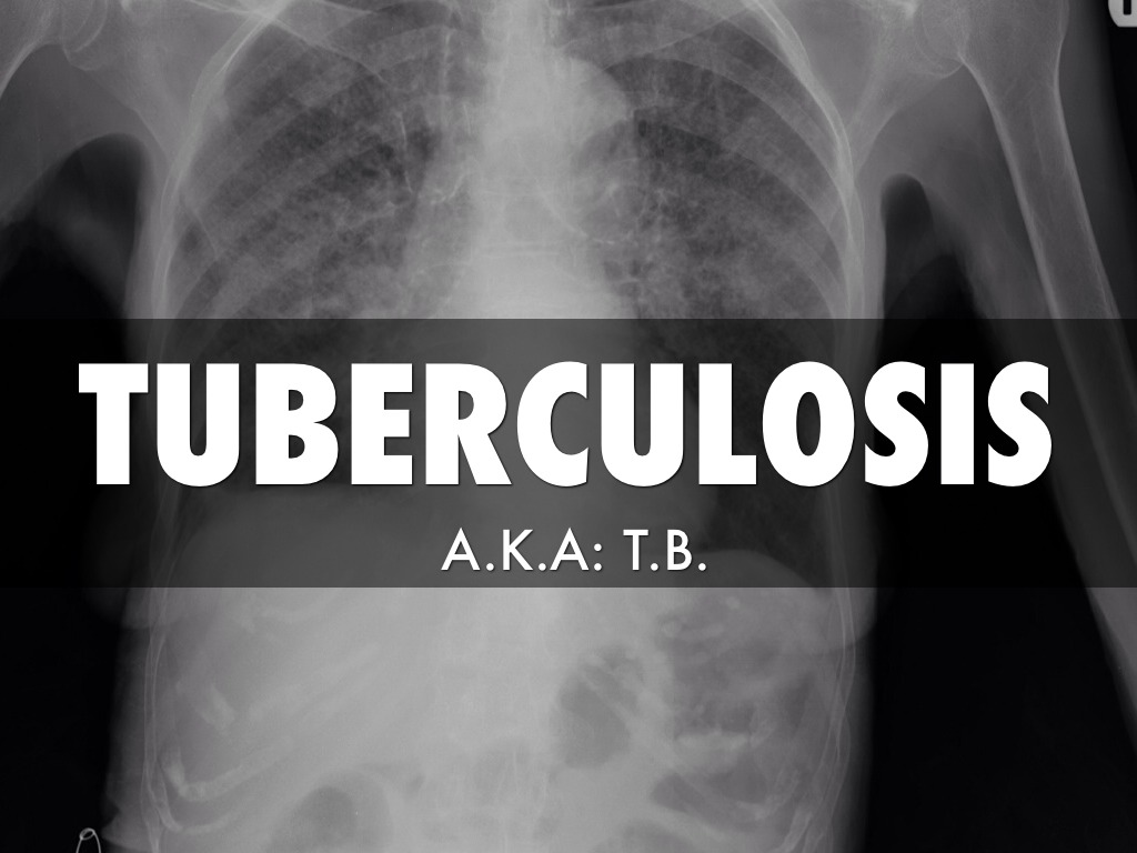 Tuberculosis 