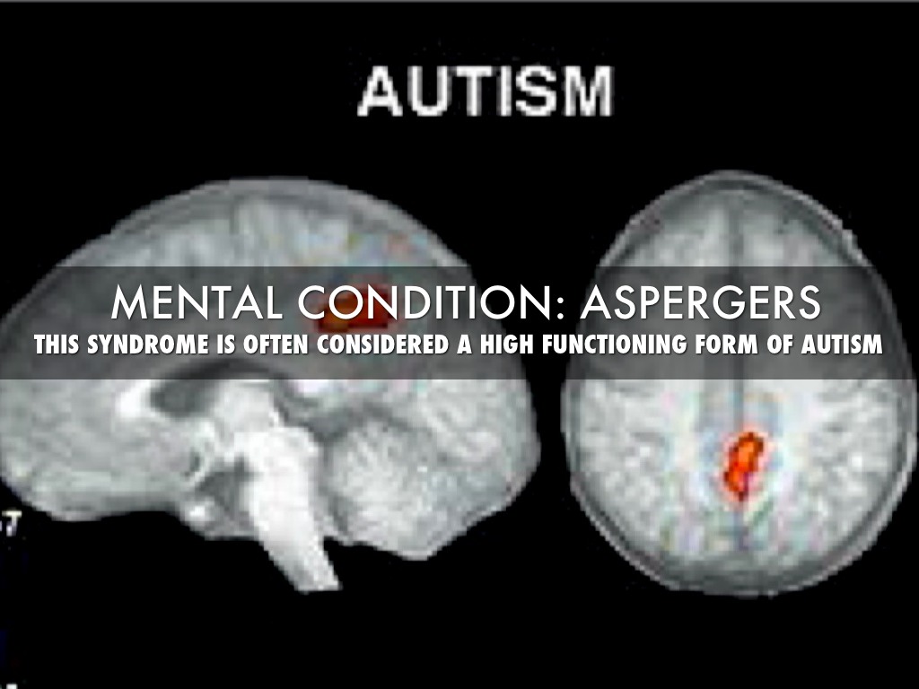 Aspergers Syndrome Brain Scan 5390