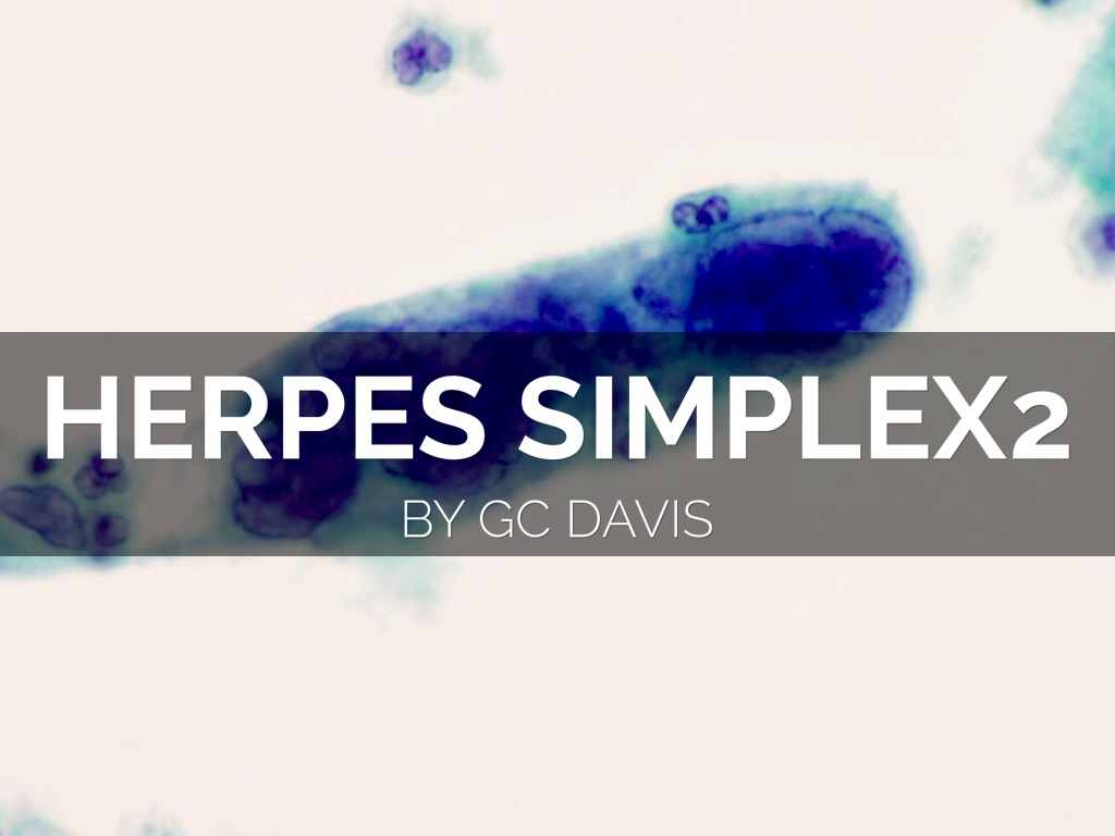 Herpes Simplex 2