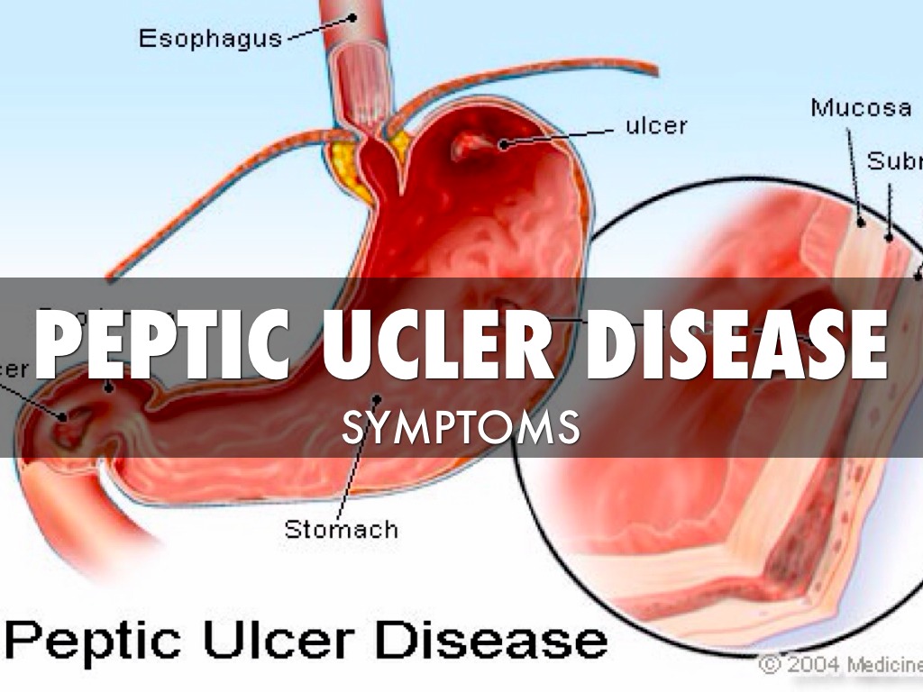 Peptic Ulcer 