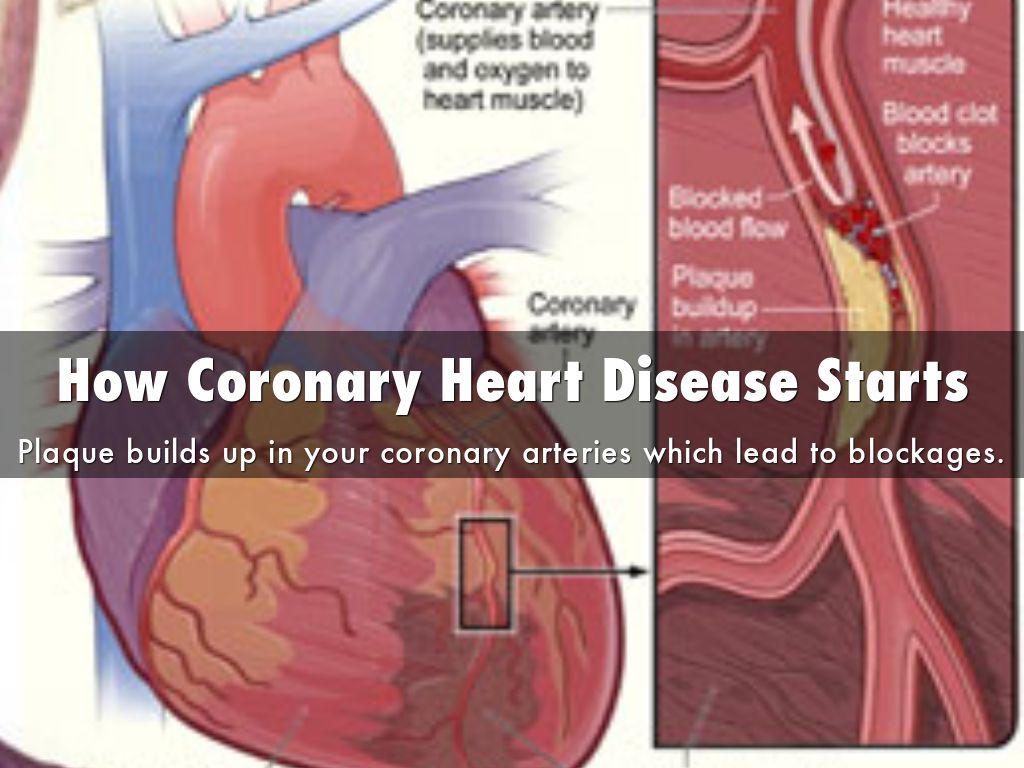 coronary-artery-disease-by-trevorhachen
