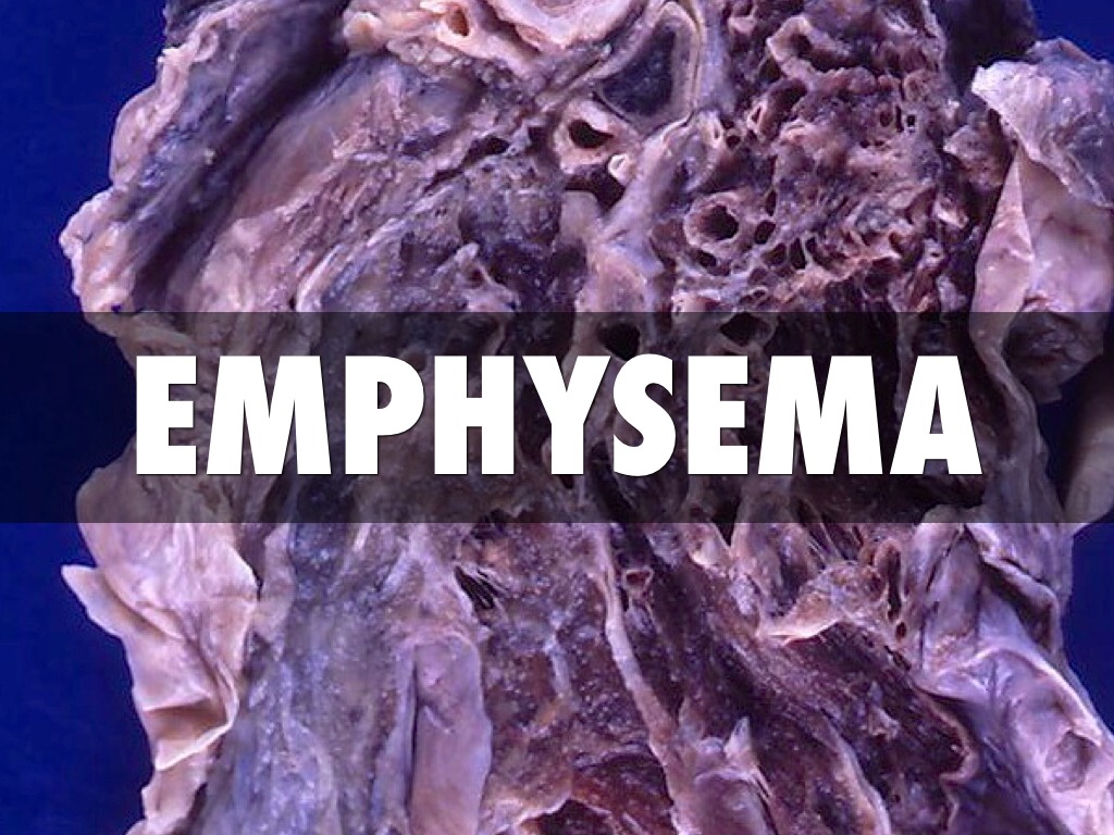 Emphysema