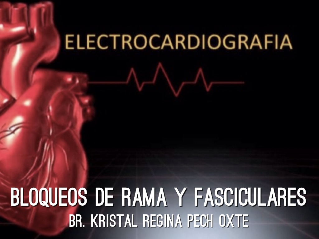 Bloqueos de rama y fasciculares