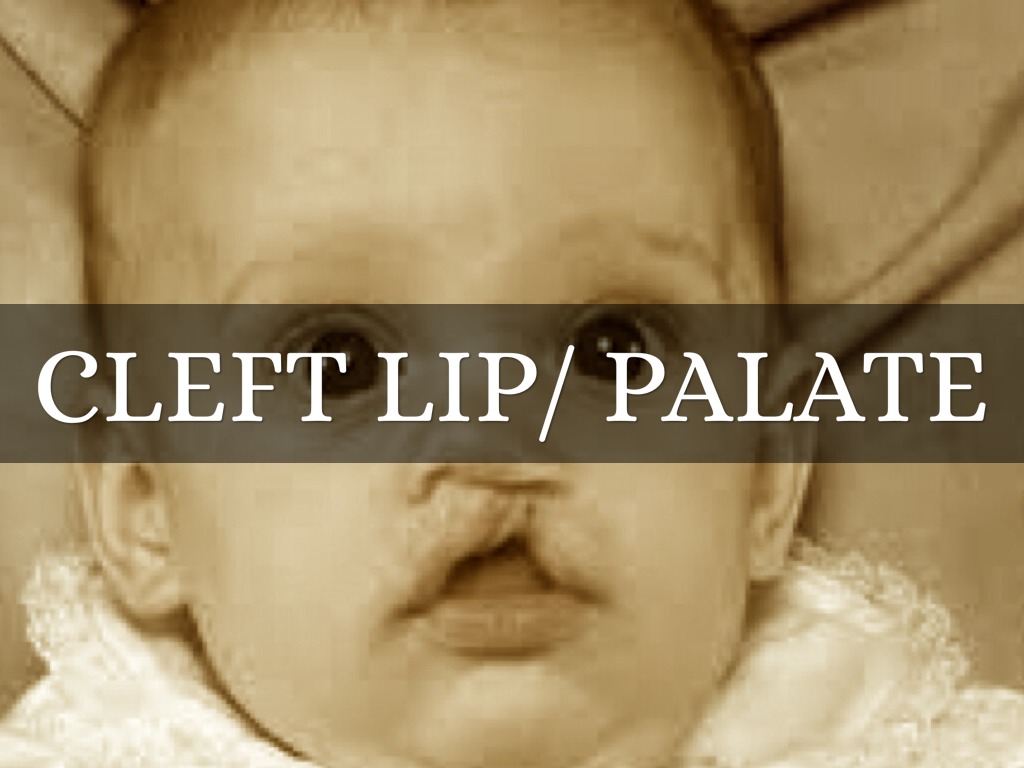 Cleft Lip 