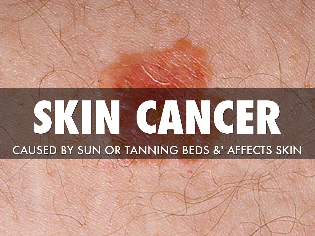 Tanning Bed Skin Cancer