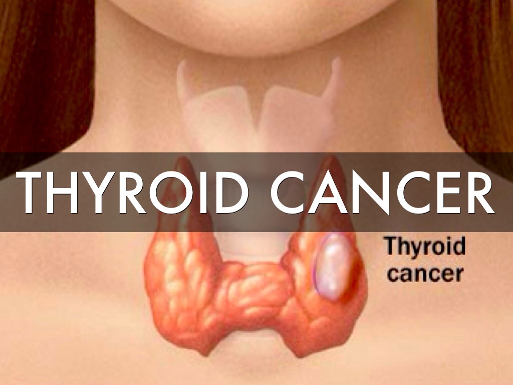 Thyroid Cancer