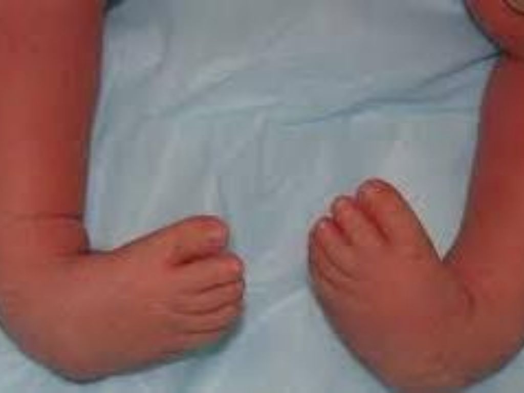 Club Foot