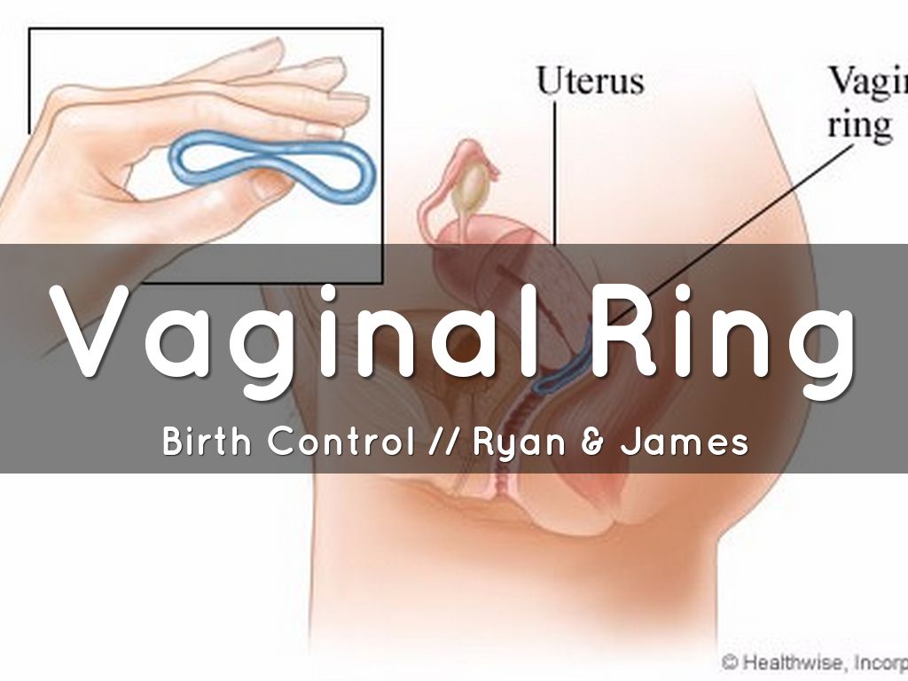 Vaginal Ring 