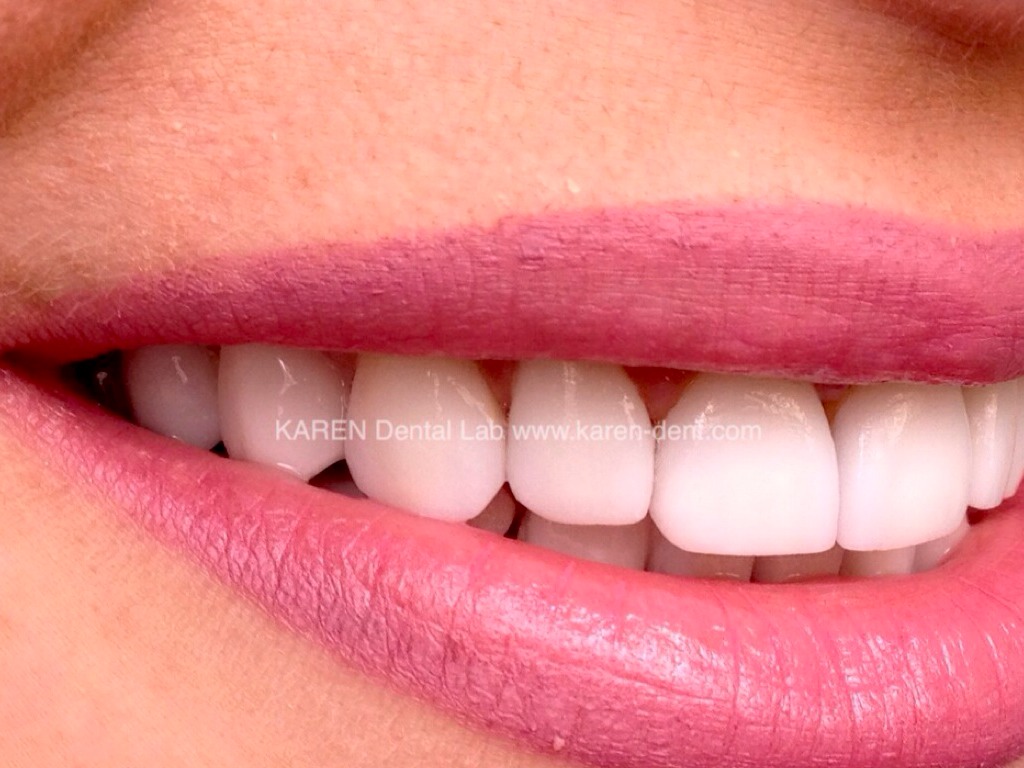 Veneers