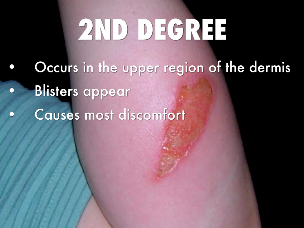 1st,2nd,3rd Degree Burns by Kyler Goens