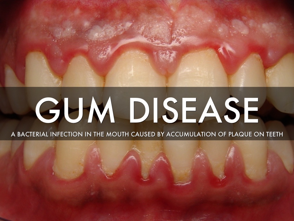 Gum Disease From Chewing Tobacco
