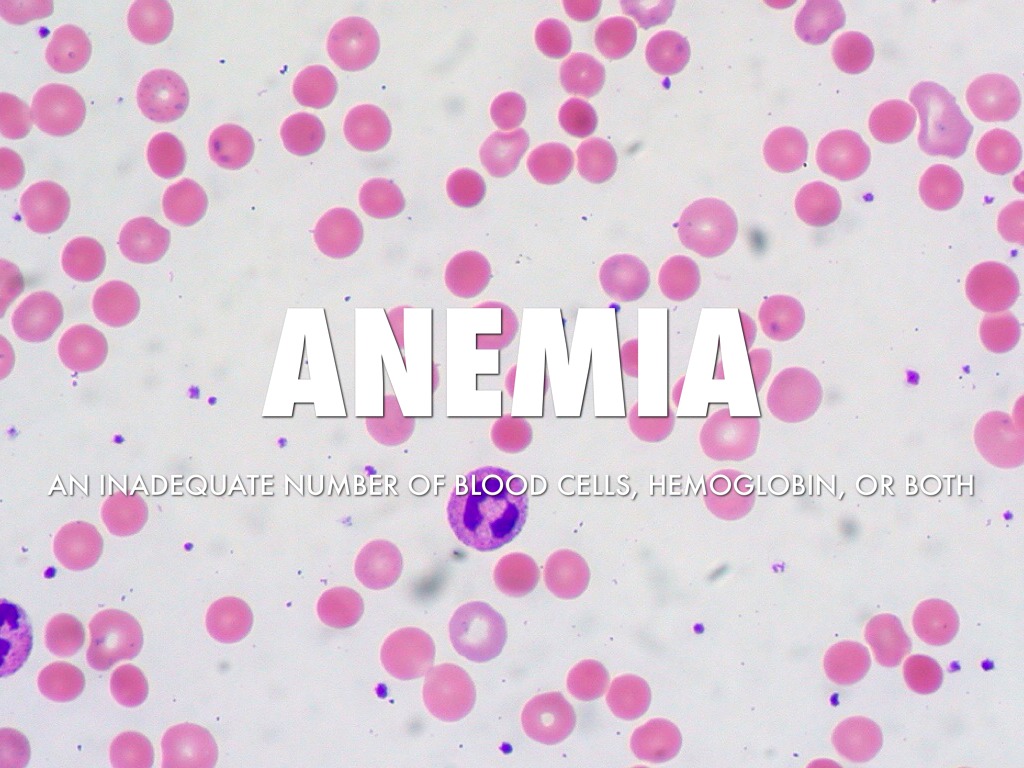 Anemia