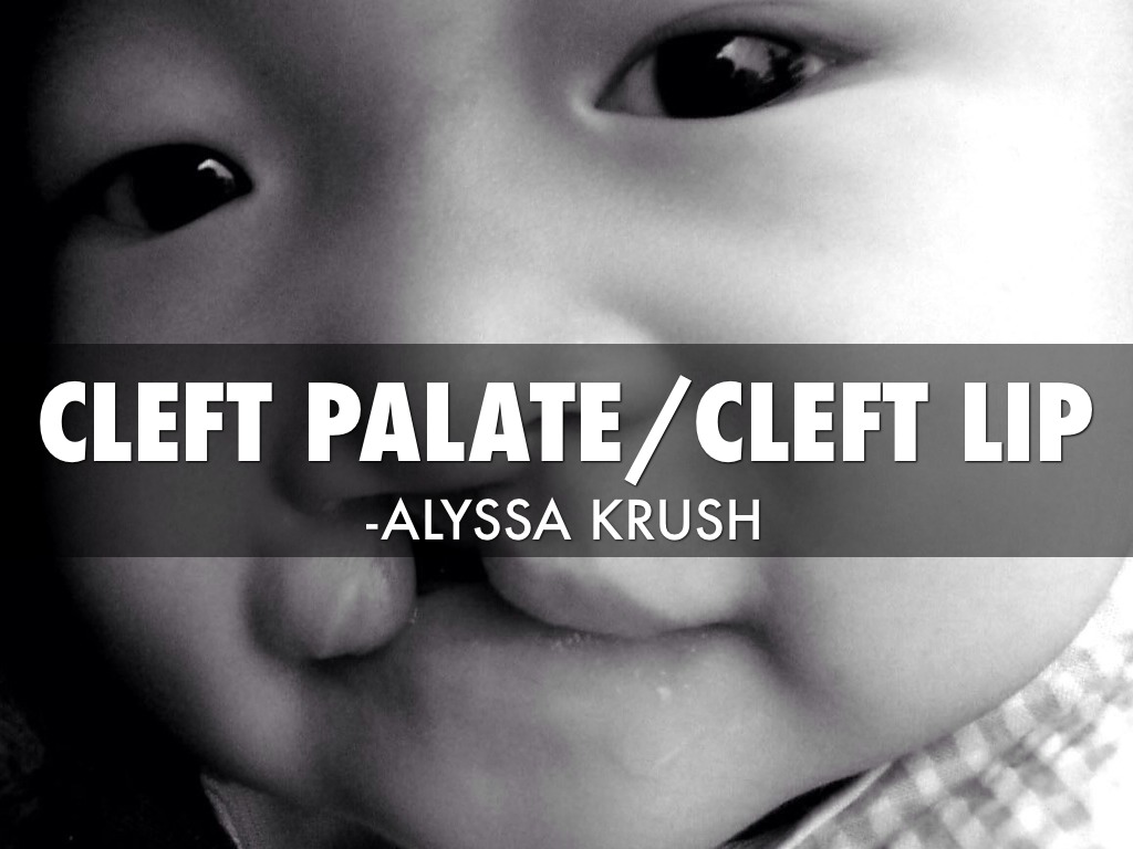 Cleft Palate
