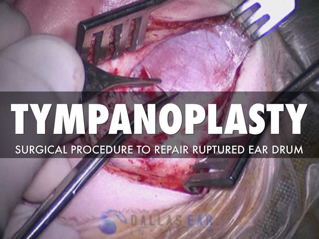 Tympanoplasty 
