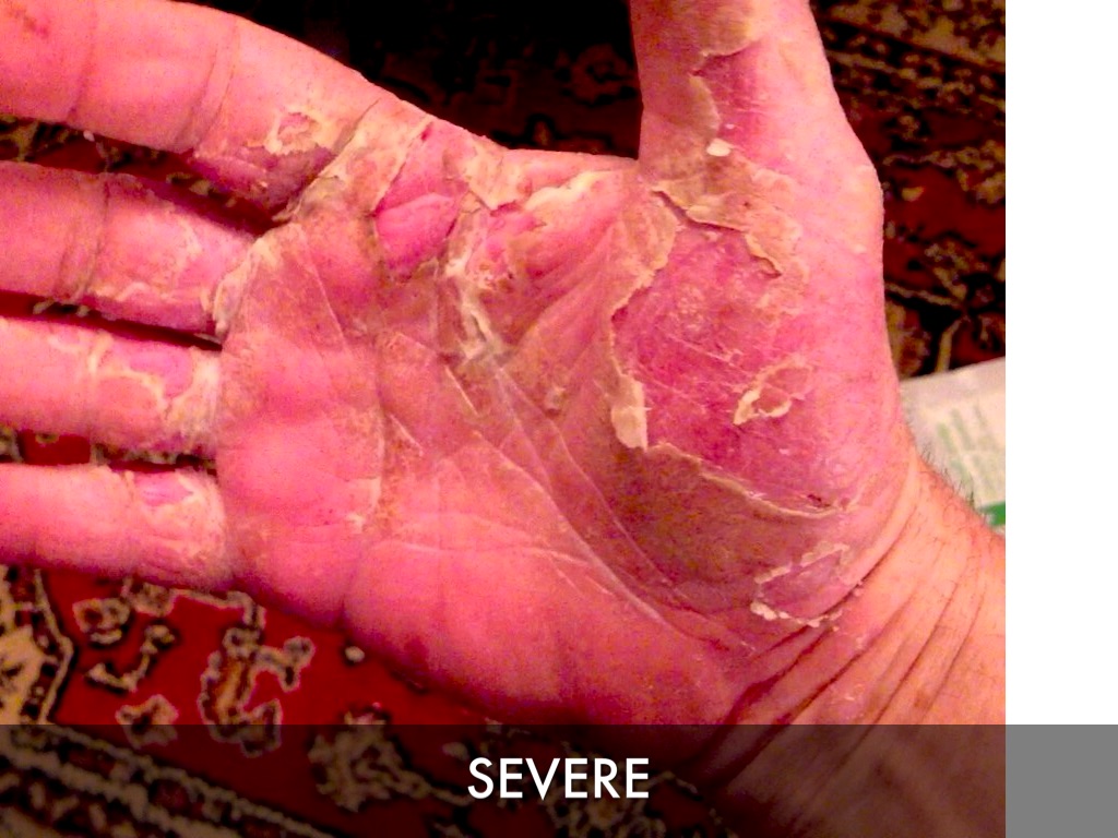 Picture of Flea Bites - WebMD Picture of Flea Bites - WebMD