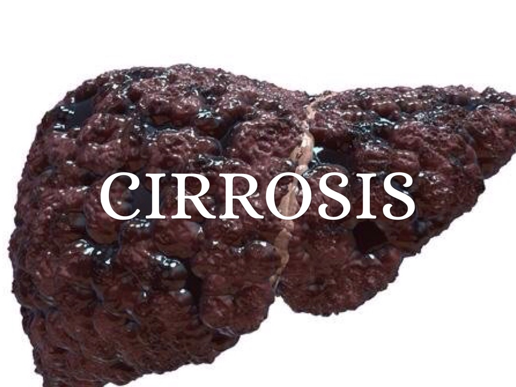 Cirrosis