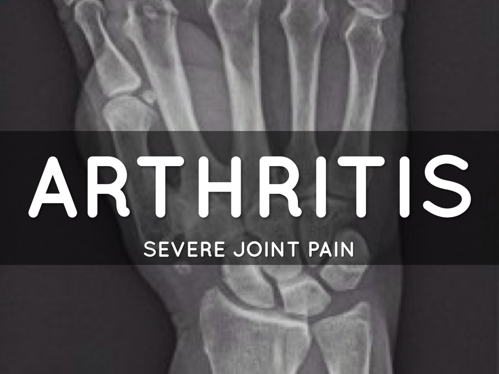 Arthritis