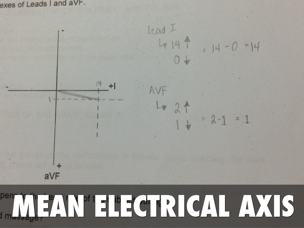 ECG Interpretation by Vanessa Lasmarias