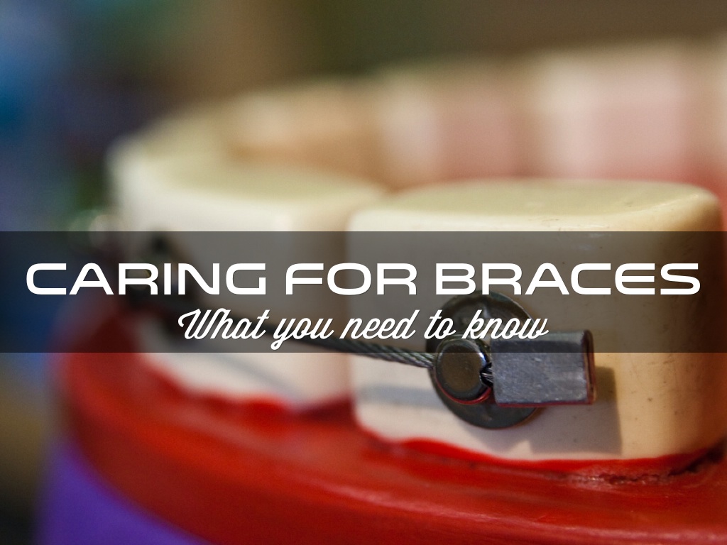 alana campkin- caring for braces