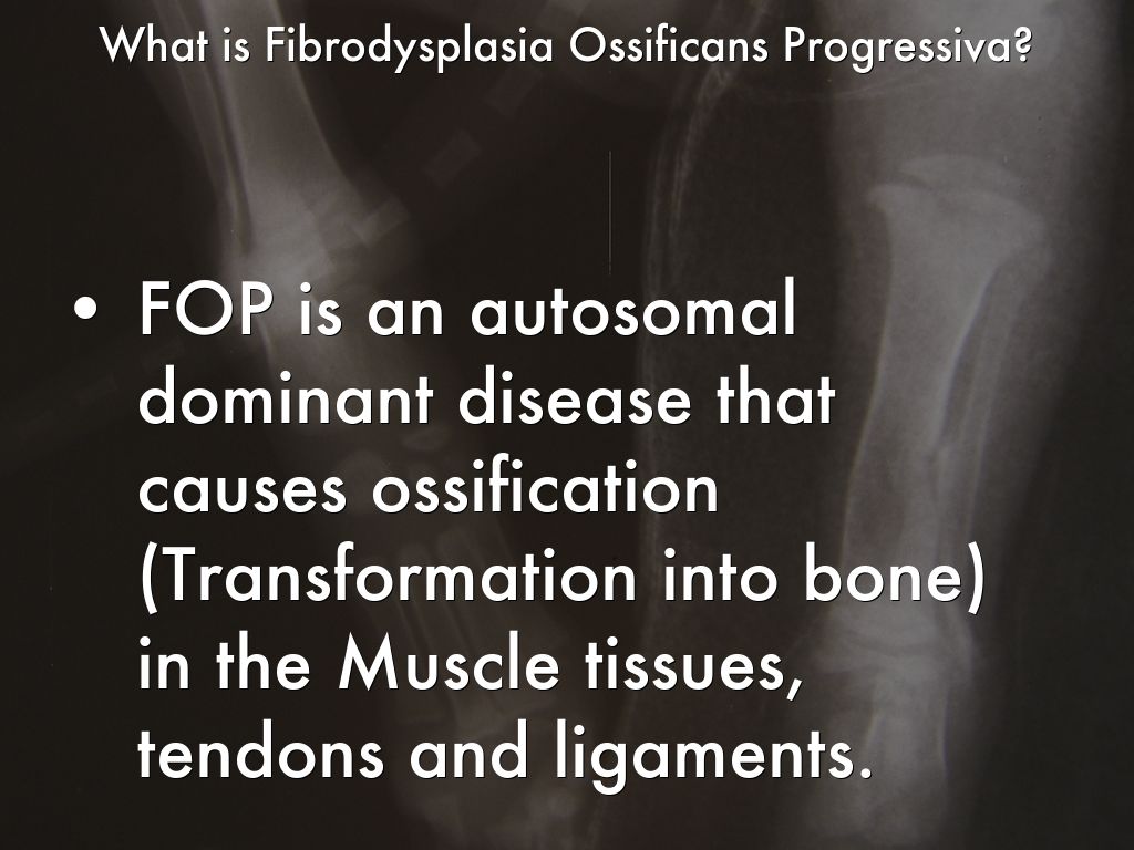fibrodysplasia ossificans progressiva is a disorder of Fibrodysplasia ossificans progressiva (fop) is a condition in which bone grows outside the skeleton abnormal bone growth replaces connective tissue, including tendons and ligaments. fibrodysplasia ossificans progressiva is a disorder of Fibrodysplasia ossificans progressiva (fop) is a condition in which bone grows outside the skeleton abnormal bone growth replaces connective tissue, including tendons and ligaments.